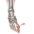 Valgus deformity of the big toe. Bones on the feet or bumps on the feet, gout. Royalty Free Stock Photo